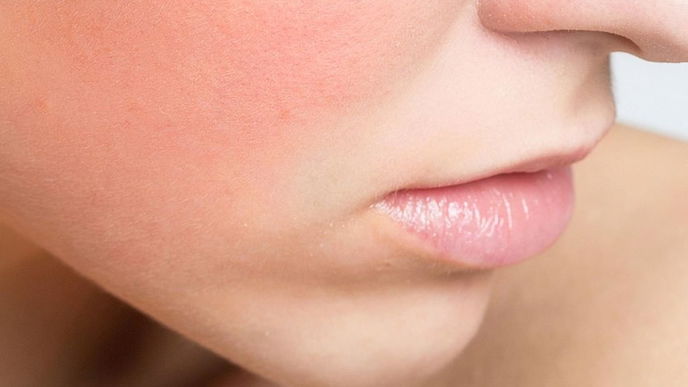 Gesichtsrötungen adé! Diese Pflege ist alles, was Sie brauchen