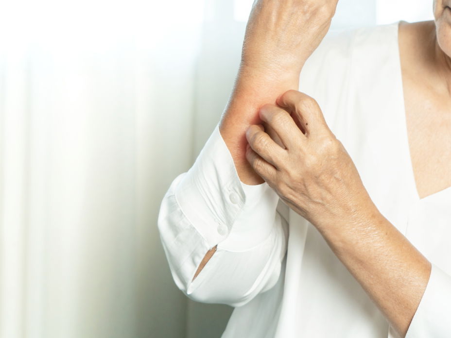 Neurodermitis: 5 Trigger, die die Krankheit auslösen