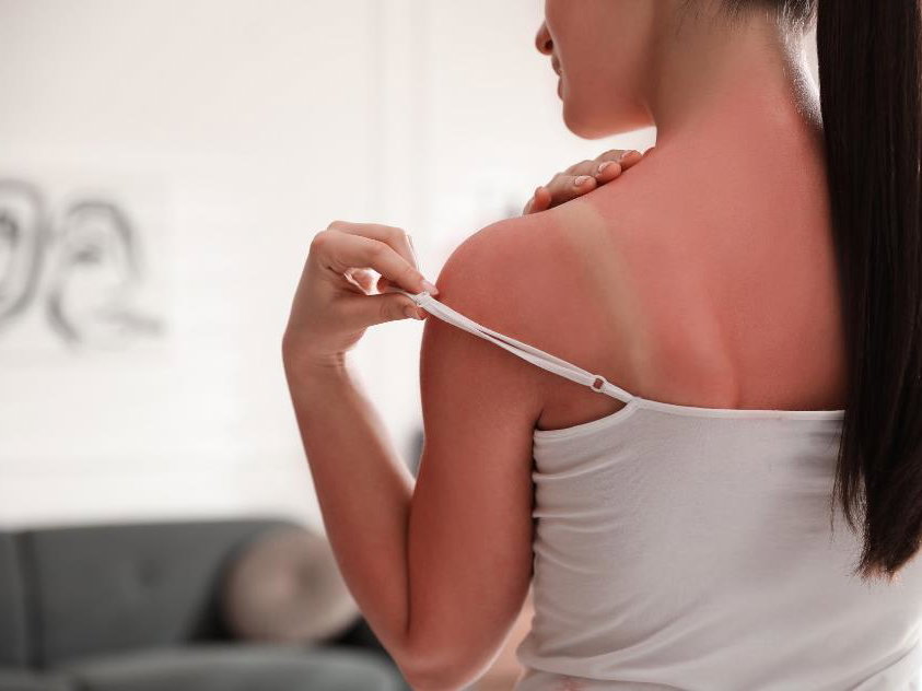 Sonnenbrand