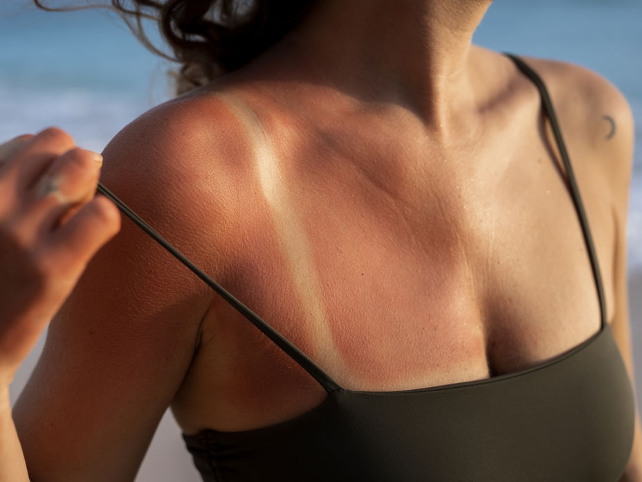 Frau mit Sonnenbrand