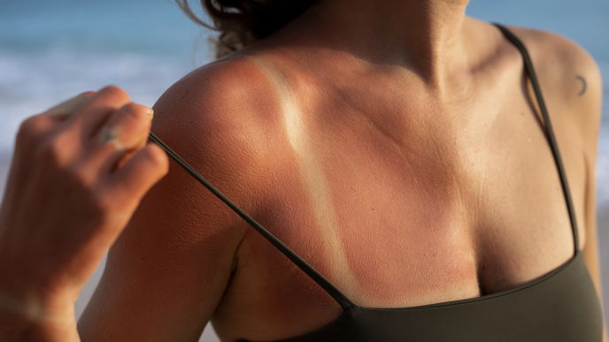 Darum sollten Sie Sonnenbrand niemals mit Eis kühlen