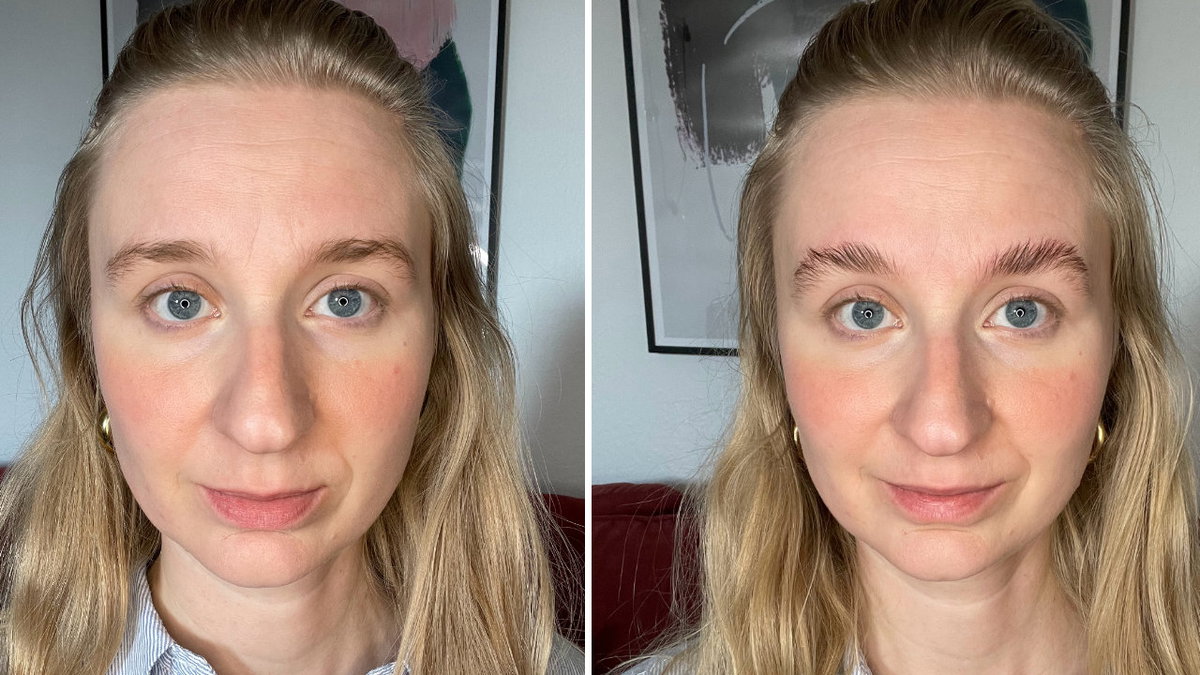 Brow Lift vorher und nachher