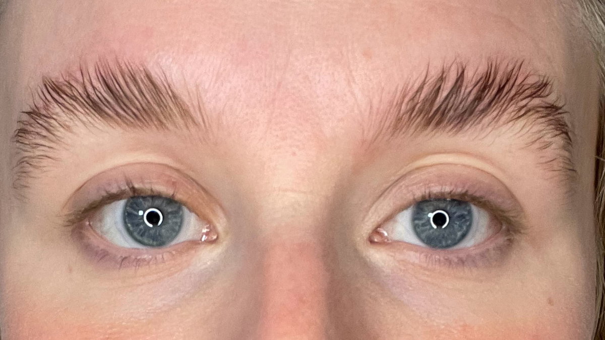 Ergebnis von einem Brow Lift