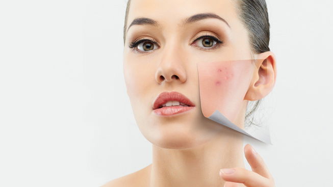 Hautkrankheit Rosacea