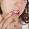 Herpes: Alle Infos über die Virusinfektion