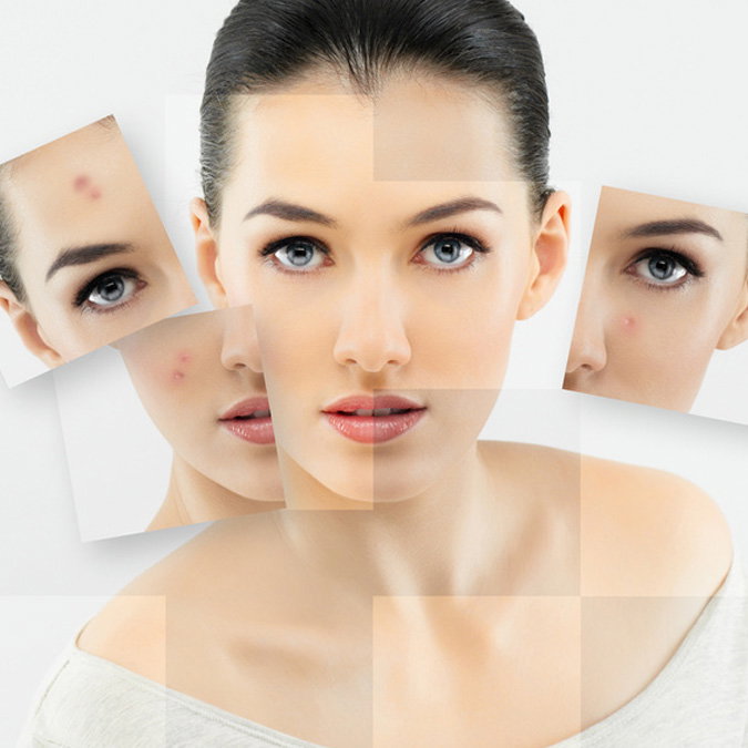 Rosacea